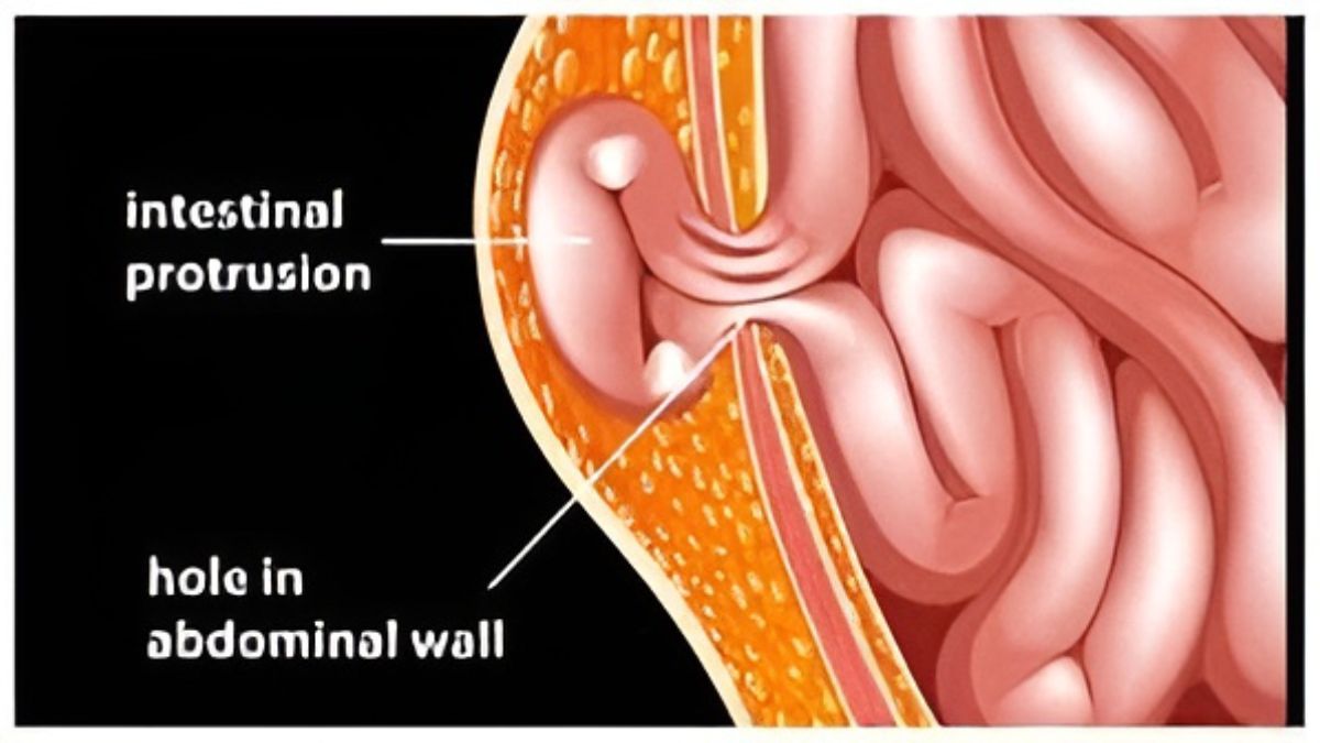 What is an Inguinal Hernia: क्या है इनगुइनल हर्निया, जिस बिमारी से पीड़ित हैं जेवलिंग स्टार नीरज चोपड़ा
